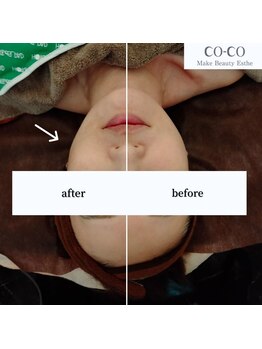 ココ センガ ビューティー クリニック(COCO SENGA Beauty-Clinic)/ジェットピール　CO-COジェット
