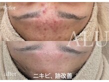 アルフォービューティー 難波店(ALU for beauty)/ニキビ・肌荒れ改善症例