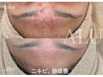 アルフォービューティー 難波店(ALU for beauty)/ニキビ・肌荒れ改善症例