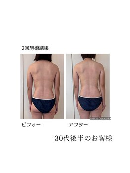 ハートエルボー(Heart elbow)/施術2回でも結果がでる