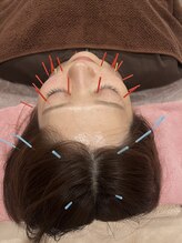 はり灸ソル(はり灸Sol)/美容鍼