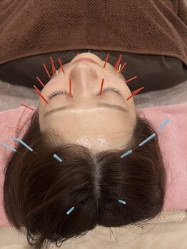 はり灸ソル(はり灸Sol)/美容鍼