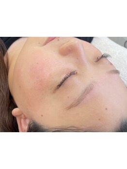 顔脱毛がしたい