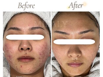 ミラリー(MIRALY)/赤みニキビケア 6ヶ月(20代前半)