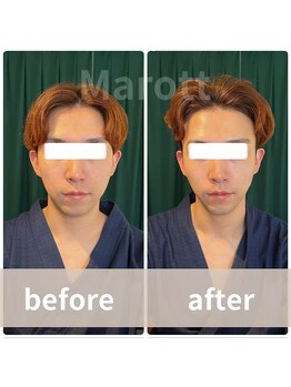 マロット 表参道店(Marott)/【30代男性】瞬間小顔たるみ改善