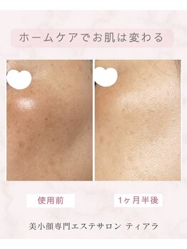 ティアラ(Tiara)/Dr.PURBEAUTE ビフォーアフター