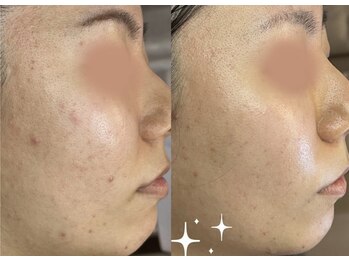 エヌエースキン 北谷店(NAskin)/ハーブピーリング｜ニキビケア