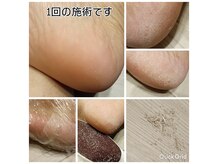 サロン オリーブ(Salon Olive)の雰囲気（巻き爪、深爪ケア、ハンドケアコース、フットケアコース準備中）