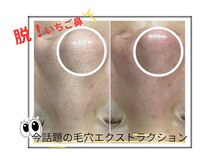 ピエル 柏店(PIEL)の雰囲気（【話題の毛穴エクストラクション】脱！いちご鼻で毛穴レス）