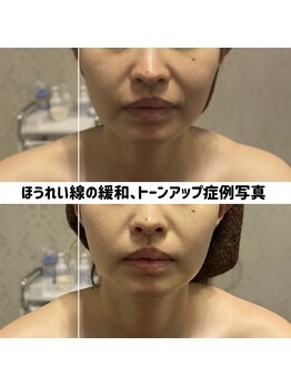 リジェ(Rege)/30代女性の方　施術