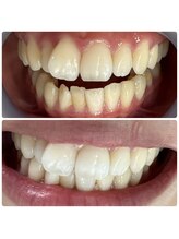 ラブホワイトニング 渋谷店(LOVEホワイトニング)/初回２回照射ホワイトニング