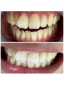 ラブホワイトニング 渋谷店(LOVEホワイトニング)/初回2回照射ホワイトニング