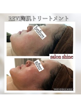 サロンシャイン(Salon Shine)/むくみを取りたい方は是非！小顔