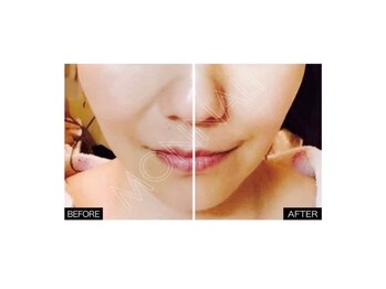 セルヴィ(Cellvi)/【復元パック】