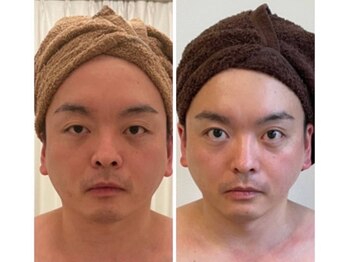 美人バスト 札幌店/小顔コルギ◇症例◇バストアップ