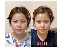 小顔22 ボルティ 本店(Bolty)/初回・2回目