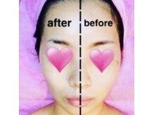 フェイスアンドボディ マーヤ(Face&Body MA-YA)の雰囲気（小顔矯正の前後の写真です【毛穴/ヘッドスパ/痩身フェイシャル】）