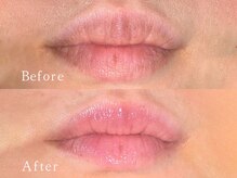 クリアー(CLEAR.)/【Before＆After】ローマピンク