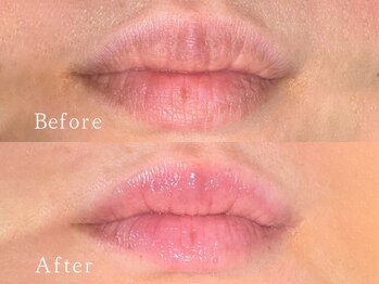 クリアー(CLEAR.)/【Before＆After】ローマピンク