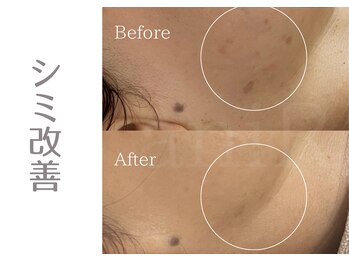 アニール(aniR)/ハーブピーリング/首ケア/毛穴