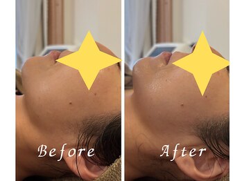 アイリーボーテ 東大阪(アイリーBEAUTE)/小顔/引き締め