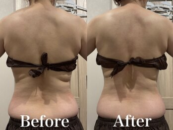 モリタ鍼灸整骨院/【ラジオ波】ボディメイク