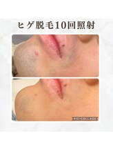 ボゴス(BOGOSS)/ヒゲ脱毛10回照射