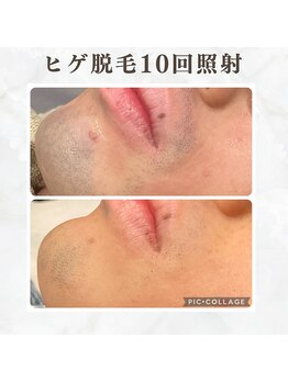 ボゴス(BOGOSS)/ヒゲ脱毛10回照射