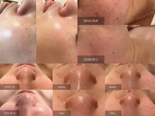 パルタージュ 三宮(Partage)の雰囲気（奨励多数の延べ１万人以上施術実績。毛穴ケア/たるみ改善/小顔）