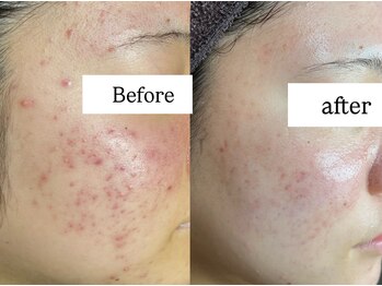 ダリア(Dahlia)/剥離ありハーブピーリング