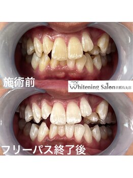 ホワイトニングサロン 京都烏丸店/ホワイトニング施術例