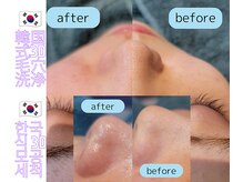 ラデュープラス(Radieux+)/【韓国式３D毛穴洗浄】