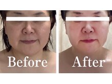 リリア(Lilia)/小顔矯正リンパ＋高周波ＥＭＳ