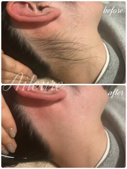 エルール トータルビューティ(Aileure total beauty)/うなじ美人　うなじ脱毛