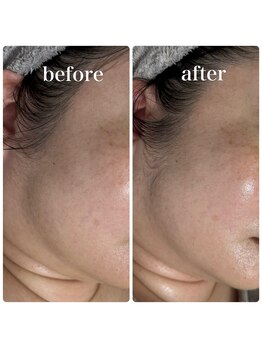 エステサロンブランシュ(Esthe salon Blanche)/ハイパーナイフフェイシャル