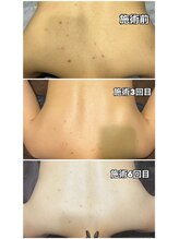 ピーチベル 美濃加茂店(PeachBell)/背中集中美肌ケア