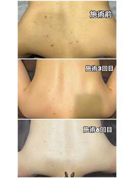 ピーチベル 美濃加茂店(PeachBell)/背中集中美肌ケア