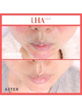 エステ＆リラク 宮/ 毛穴ララピール：BeforeAfter