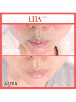 エステ&リラク 宮/ 毛穴ララピール:BeforeAfter