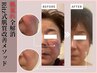 ★【3回目まで&1ヶ月以内の来店限定】小顔＋肌質改善施術90分¥15,900