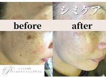 パールホワイトニングサロン 平塚店/輪郭のあるシミ改善◎