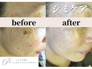 パールホワイトニングサロン 平塚店/輪郭のあるシミ改善◎