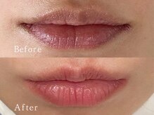 クリアー(CLEAR.)/【Before＆After】ローマピンク