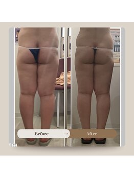 プラチナアース つくば店(Platinum earth)/痩身ビフォーアフター