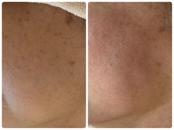 アリスビューティー(AliceBeauty)/プラズマシャワーの嬉しい効果