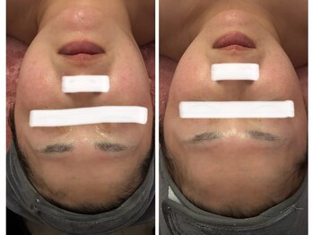 ユフラ(Juhla)/切らない小顔リフト