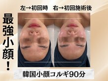 イヨヨ(iyoyo)/【小顔コルギ90分】Before After