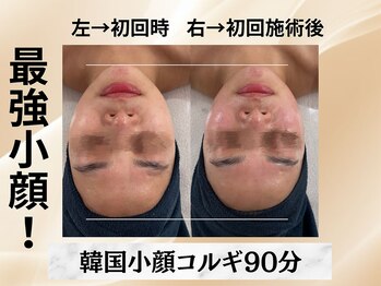 イヨヨ(iyoyo)/【小顔コルギ90分】Before After