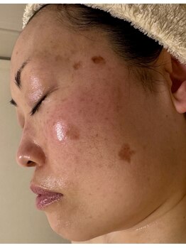 ラシェプリズ(LACHER PRISE)/施術経過（40代）