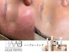 【ニキビ・凸凹跡・シミ】No.1ハーブピーリング｜￥22,000→￥16,500